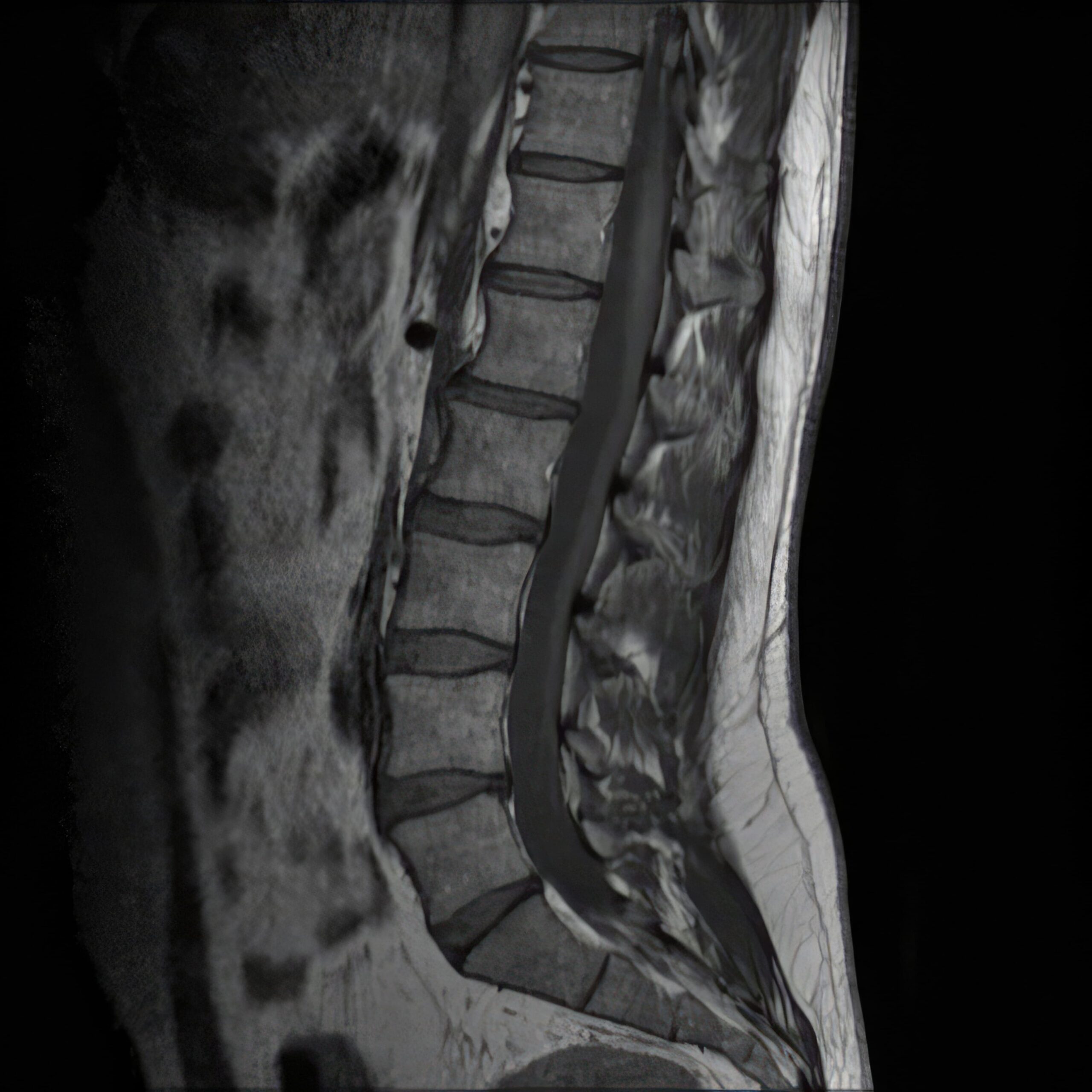 Lumbar Spine MRI Image