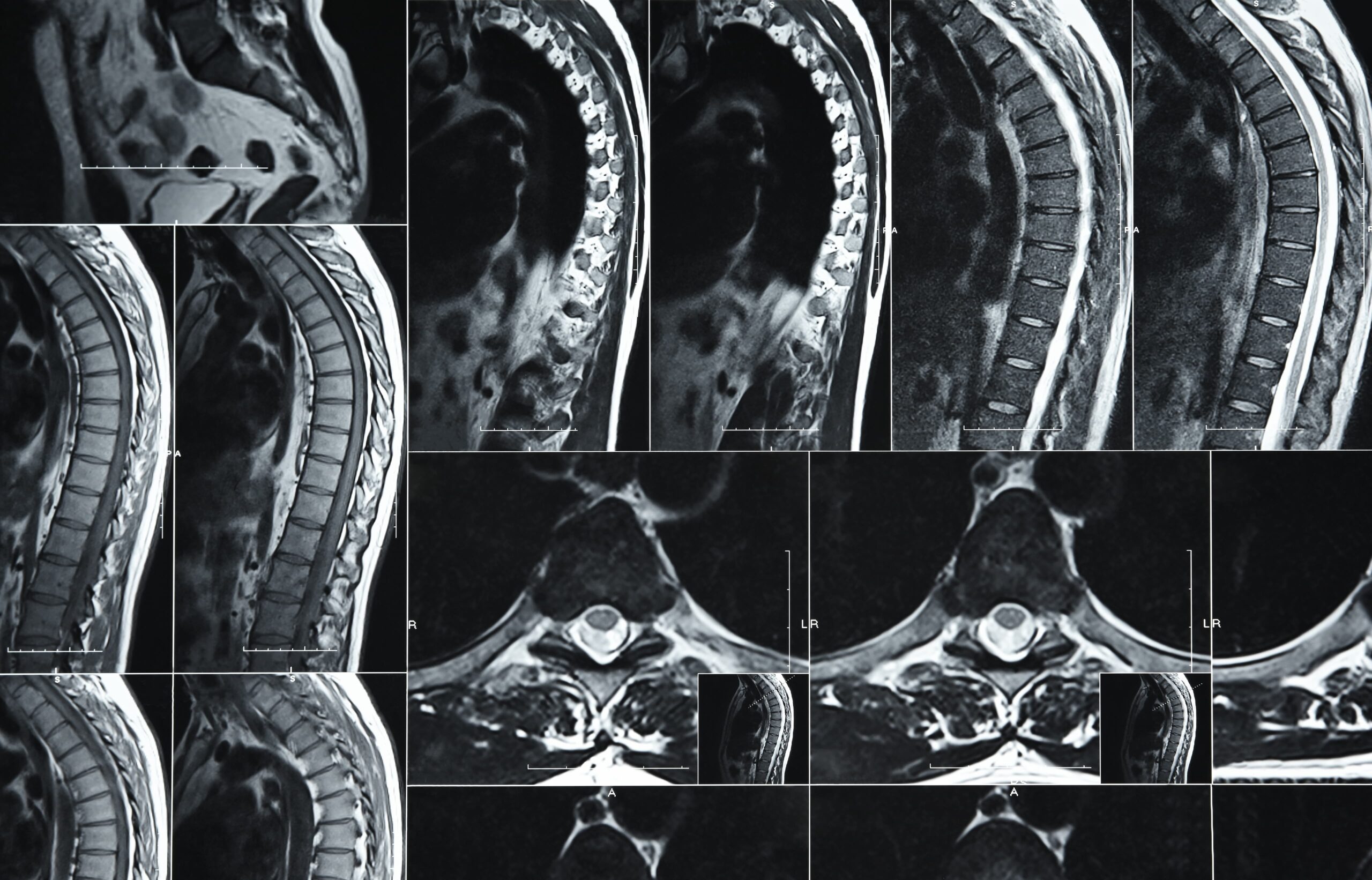 Thoracic Spine MRI Image